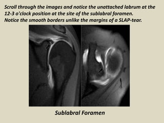Scroll through the images and notice the unattached labrum at the
12-3 o'clock position at the site of the sublabral foramen.
Notice the smooth borders unlike the margins of a SLAP-tear.
Sublabral Foramen
 
