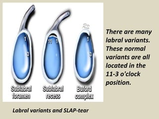 Labral variants and SLAP-tear
There are many
labral variants.
These normal
variants are all
located in the
11-3 o'clock
position.
 
