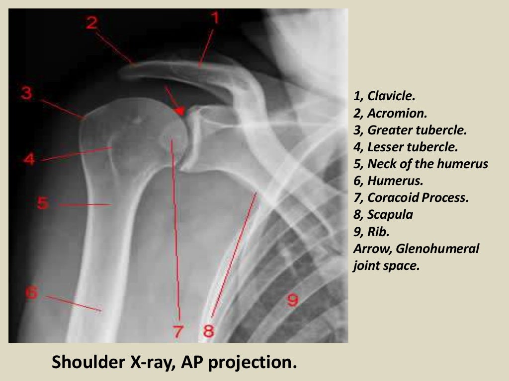 Presentation1.pptx, radiological anatomy of the shoulder joint.