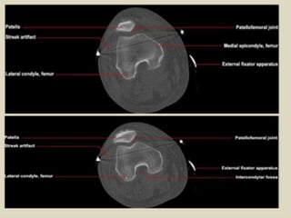 Terminal J Sign Presentation1.pptx, radiological anatomy of the knee joint. | PPTX