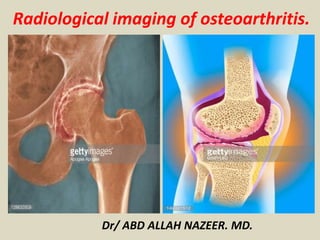 Radiological imaging of osteoarthritis.
Dr/ ABD ALLAH NAZEER. MD.
 