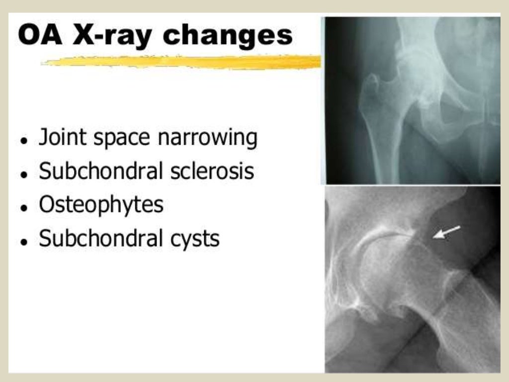 Presentation1.pptx, radiological imaging of osteoarthritis.