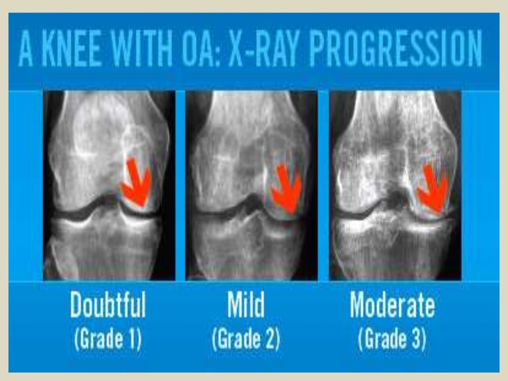 Presentation1.pptx, radiological imaging of osteoarthritis.