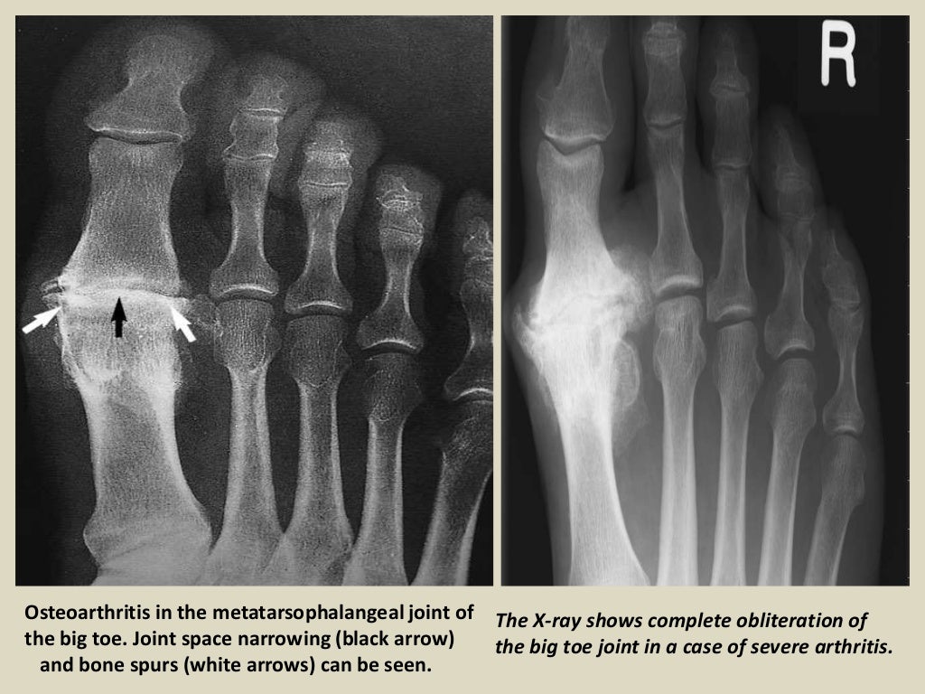 Presentation1.pptx, radiological imaging of osteoarthritis.