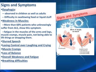 Signs and Symptoms
Dysphagia:
-- observed in children as well as adults
-- Difficulty in swallowing food or liquid stuff
Weakness in Muscles:
--More than 60% patients who unknowingly
suffer from ALS, show this symptom.
--fatigue in the muscles of the arms and legs,
muscle cramps, muscle pain, not being able to
lift things or dropping them.
Slurred Speech
Losing Control over Laughing and Crying
Muscle Cramps
Loss of Balance
Overall Weakness and Fatigue
Breathing difficulties
 