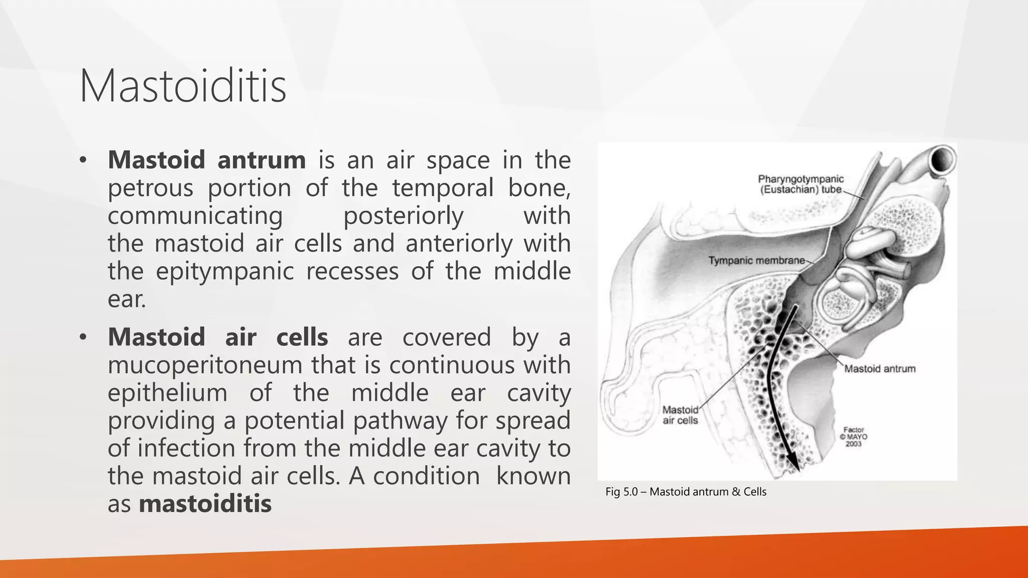 Mastoiditis
• Mastoid antrum is an air space in the
petrous portion of the temporal bone,
communicating posteriorly with
the mastoid air cells and anteriorly with
the epitympanic recesses of the middle
ear.
• Mastoid air cells are covered by a
mucoperitoneum that is continuous with
epithelium of the middle ear cavity
providing a potential pathway for spread
of infection from the middle ear cavity to
the mastoid air cells. A condition known
as mastoiditis
Fig 5.0 – Mastoid antrum & Cells
 