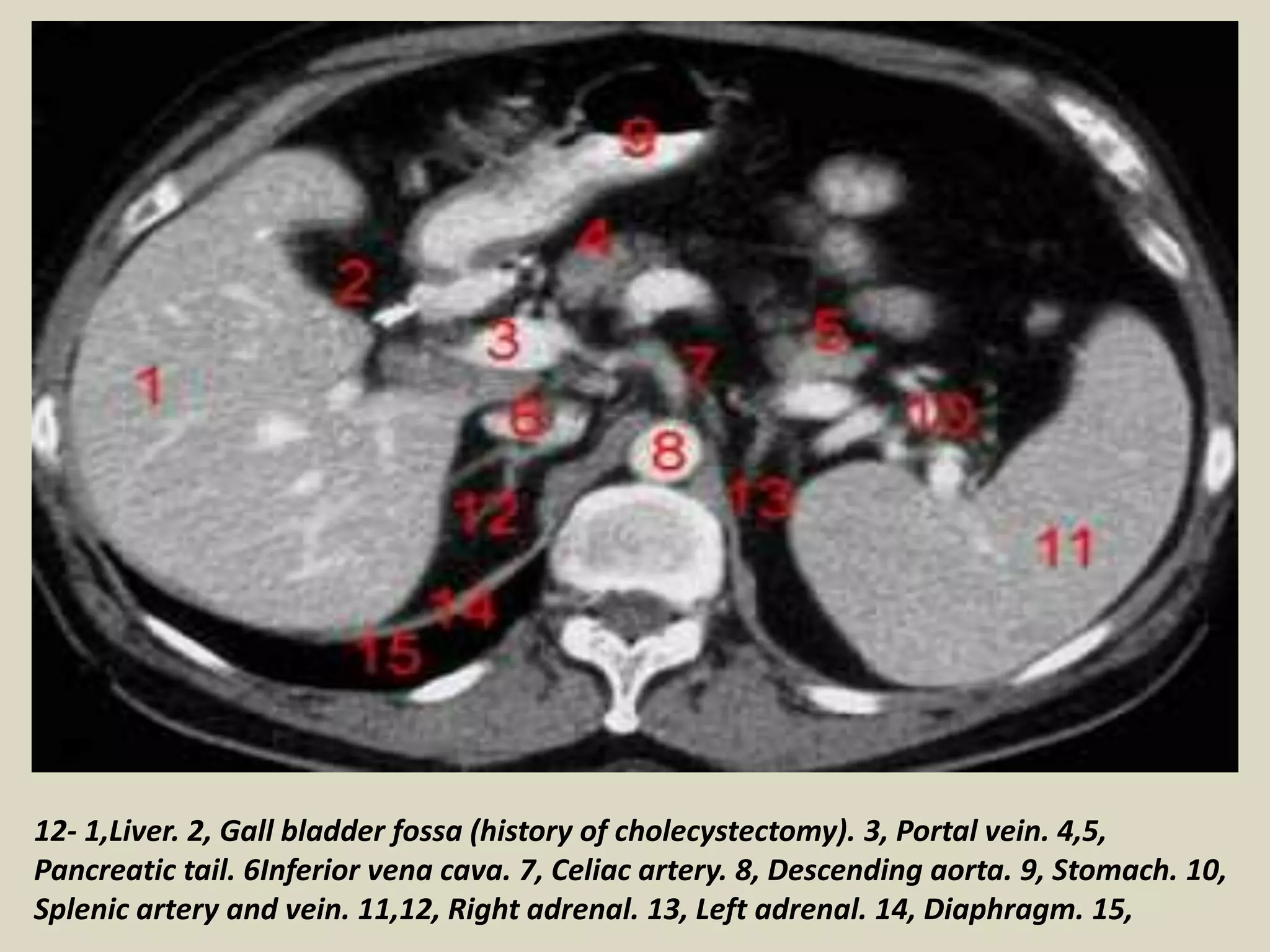 Presentation1.pptx, ct normal anatomy of the abdomen and pelvis. | PPTX