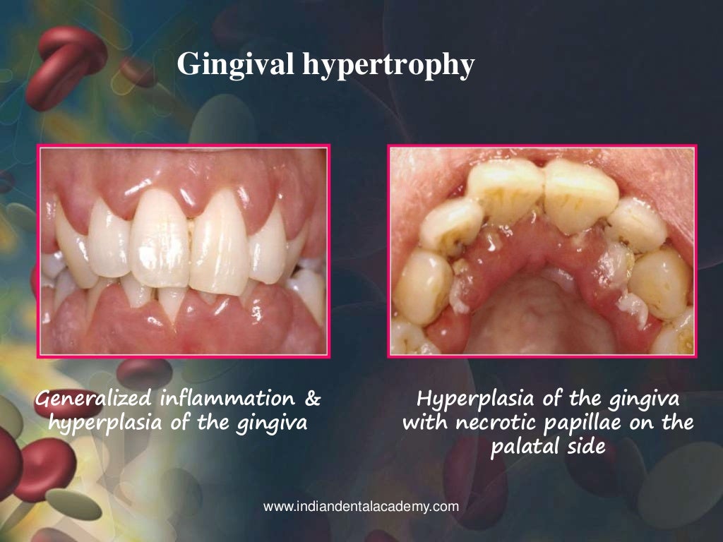 leukemia / dental implant courses