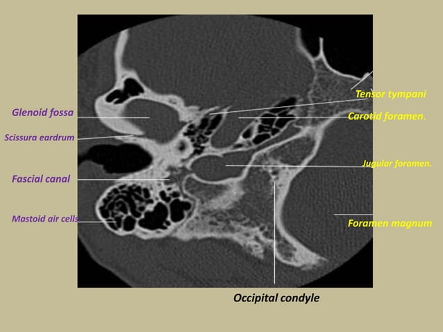 Presentation1.pptx, radiological anatomy of the petrous bone. | PPTX
