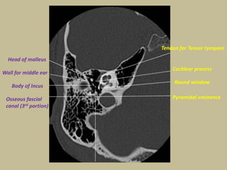 Petrous Bone Anatomy Radiology