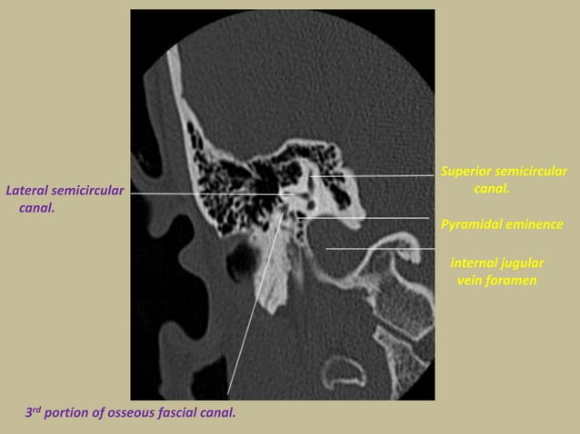 Presentation1.pptx, radiological anatomy of the petrous bone. | PPTX