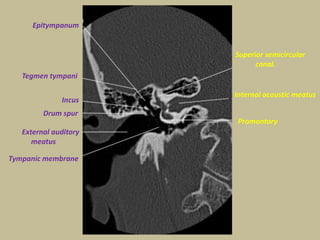 Petrous Bone Anatomy Radiology