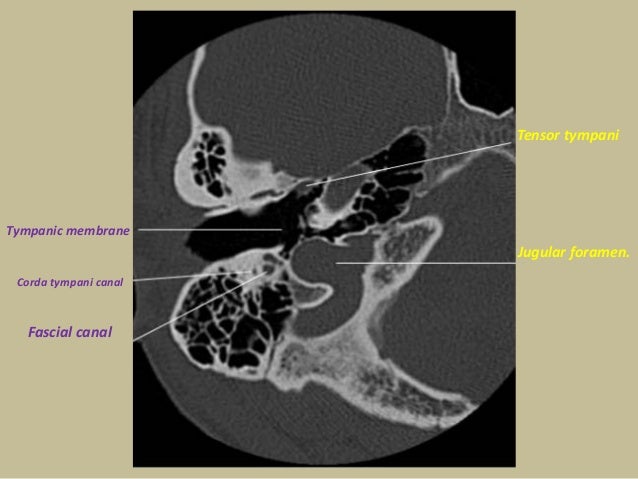 Presentation1.pptx, radiological anatomy of the petrous bone.