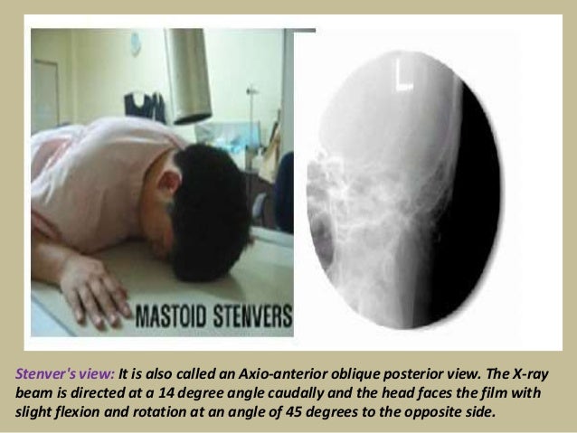 Presentation1.pptx, radiological anatomy of the petrous bone.