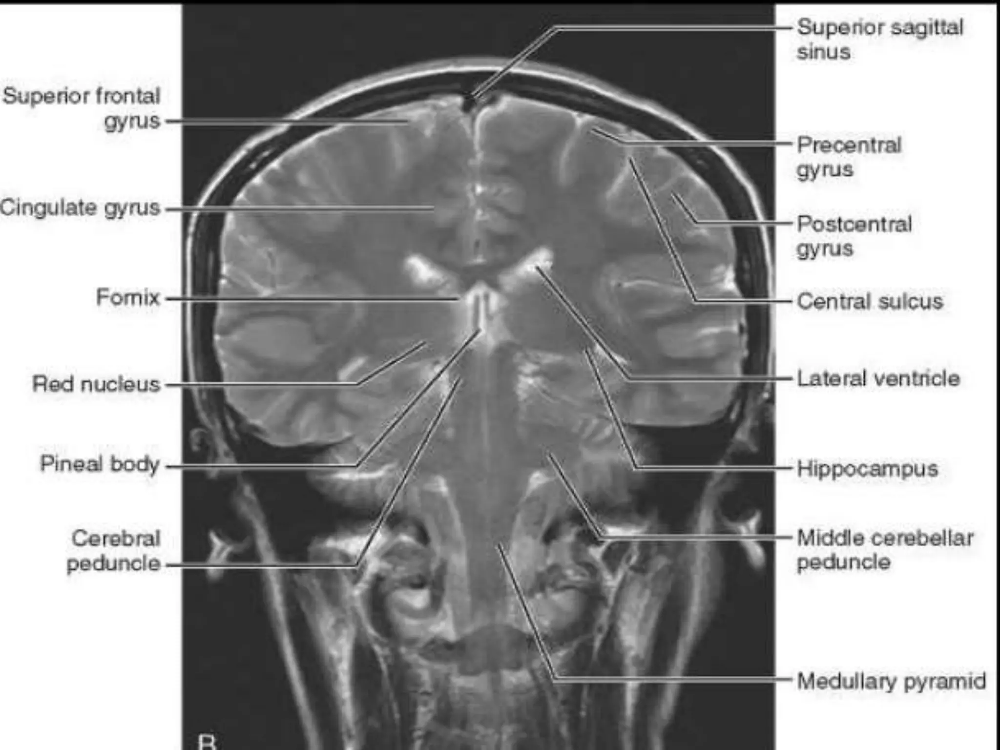 Uncus Radiopaedia Presentation1.pptx, radiological anatomy of the brain. | PPTX