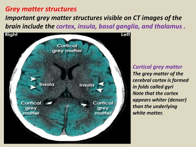 Presentation1.pptx, radiological anatomy of the brain. | PPTX | Brain ...