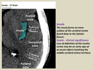 Insular Def Presentation1.pptx, radiological anatomy of the brain. | PPTX