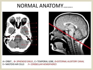 Presentation1.pptx, radiological anatomy of the brain. | PPTX