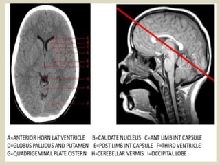 Uncus Radiopaedia Presentation1.pptx, radiological anatomy of the brain. | PPTX