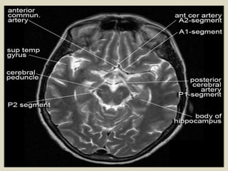 Presentation1.pptx, radiological anatomy of the brain. | PPTX