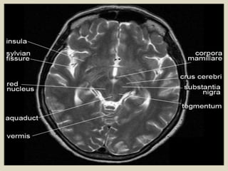 Cardunculus Brain Presentation1.pptx, radiological anatomy of the brain. | PPTX