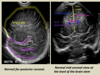 Normal far-posterior coronal.
Normal mid coronal view at
the level of the brain stem
 