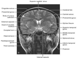 Presentation1.pptx, radiological anatomy of the brain.