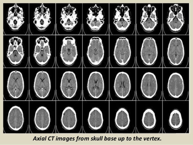 Presentation1.pptx, radiological anatomy of the brain.