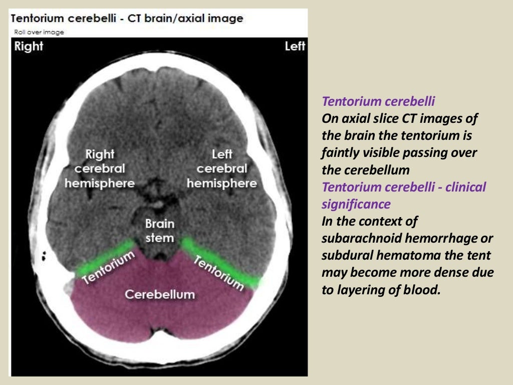 Presentation1.pptx, radiological anatomy of the brain.