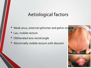 Aetiological factors
• Weak anus, external sphincter and pelvic muscle
• Lax, mobile rectum
• Obliterated ano-rectal angle
• Abnormally mobile rectum with descent
 