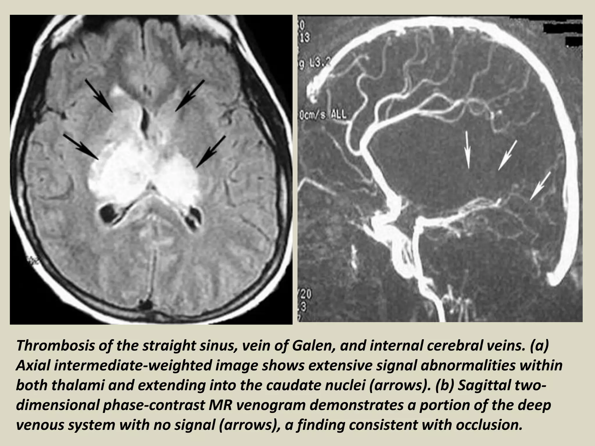 Presentation1.pptx, radiological imaging of cerebral venous thrombosis ...
