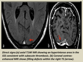 Sss Infarction Presentation1.pptx, radiological imaging of cerebral venous thrombosis ...