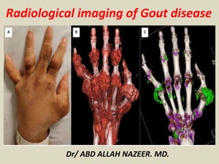 Dr/ ABD ALLAH NAZEER. MD.
Radiological imaging of Gout disease
 