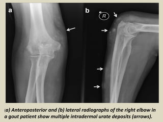Presentation1.pptx, radiological imaging of gout disease. | PPTX