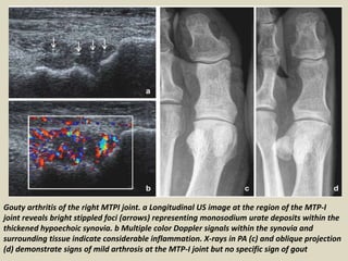 Presentation1.pptx, radiological imaging of gout disease. | PPTX