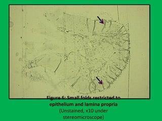 Figure 6: Small folds restricted to
epithelium and lamina propria
(Unstained, x10 under
stereomicroscope)
 