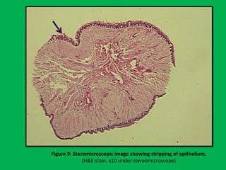Figure 9: Steromicroscopic image showing stripping of epithelium.
(H&E stain, x10 under stereomicroscope)
 