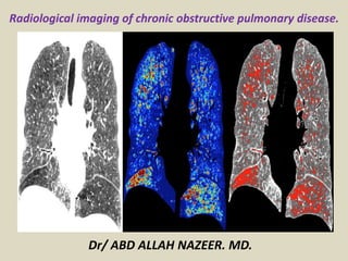 Radiological imaging of chronic obstructive pulmonary disease.
Dr/ ABD ALLAH NAZEER. MD.
 