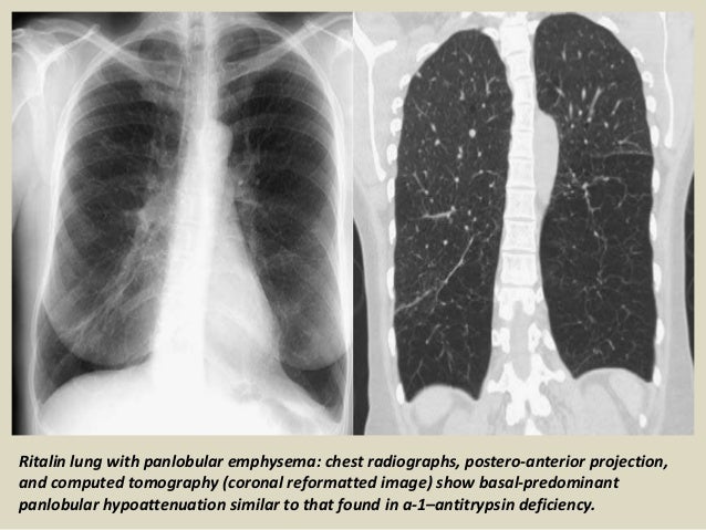 Presentation1.pptx, radiological imaging of chronic 