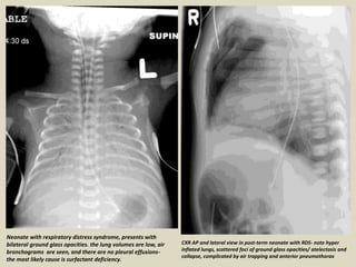 Cxr In Rds Presentation1.pptx, radiological imaging of neonatal lung disease. | PPTX