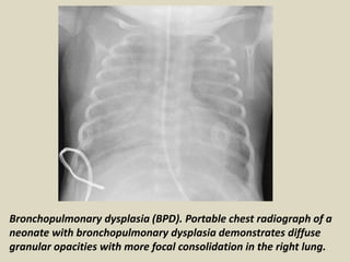 Presentation1.pptx, radiological imaging of neonatal lung disease. | PPTX