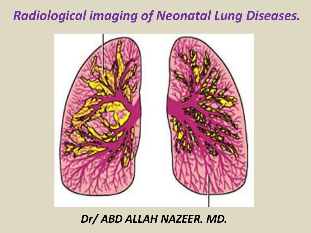 Presentation1.pptx, radiological imaging of neonatal lung disease.
