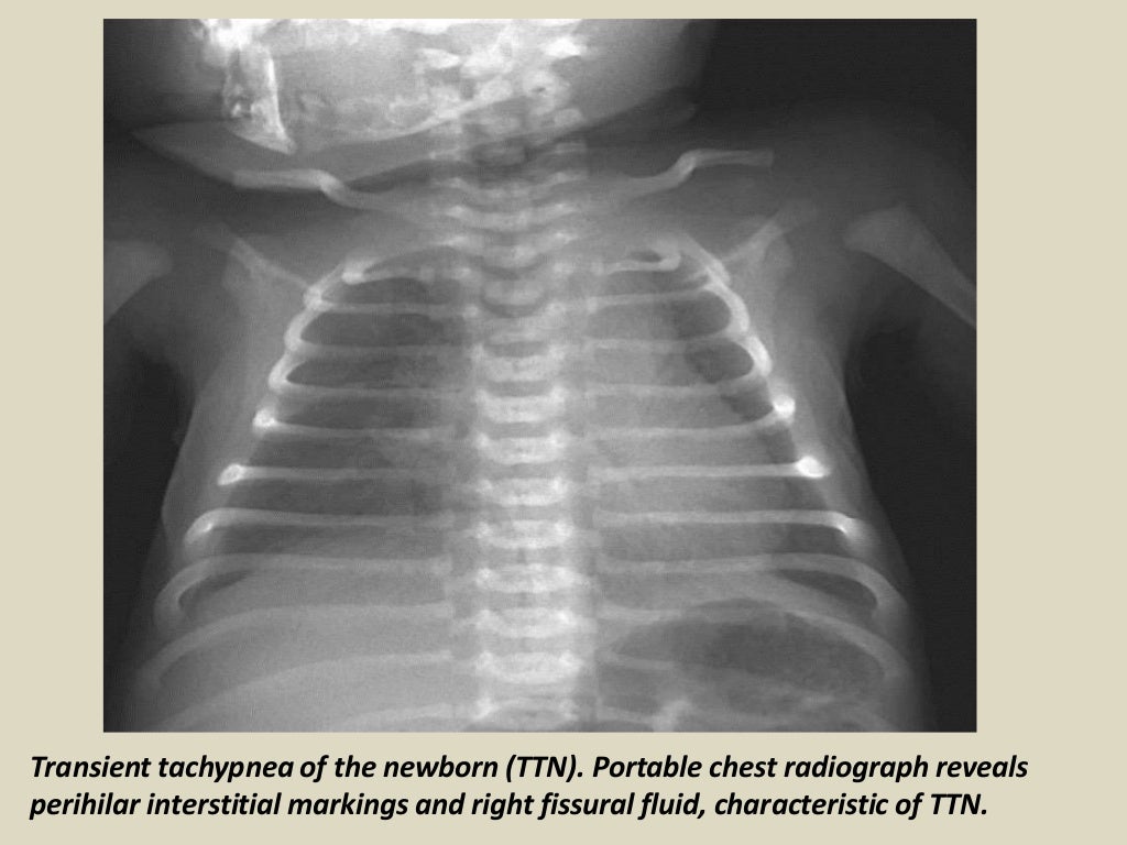 Presentation1.pptx, radiological imaging of neonatal lung disease.