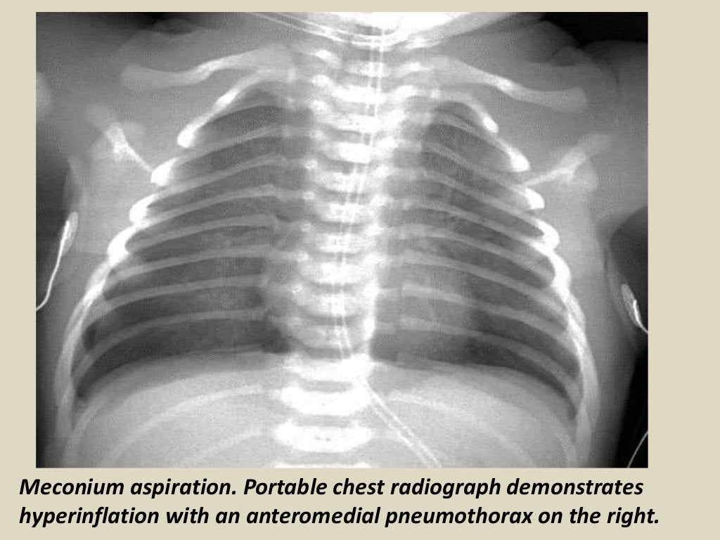 Presentation1.pptx, radiological imaging of neonatal lung disease.