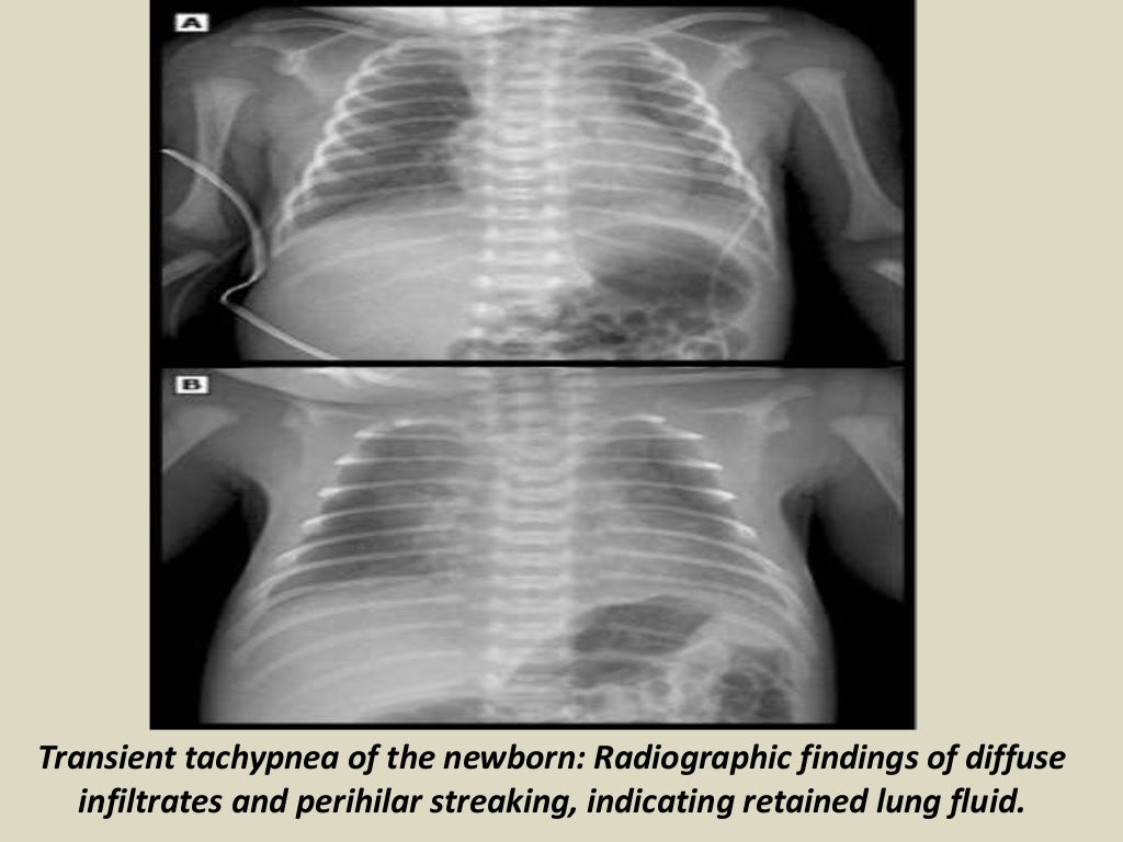 Presentation1.pptx, radiological imaging of neonatal lung disease.