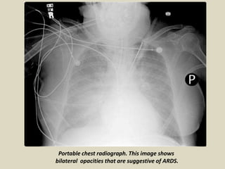 Presentation1.pptx, radiological imaging of restrictive lung diseases ...