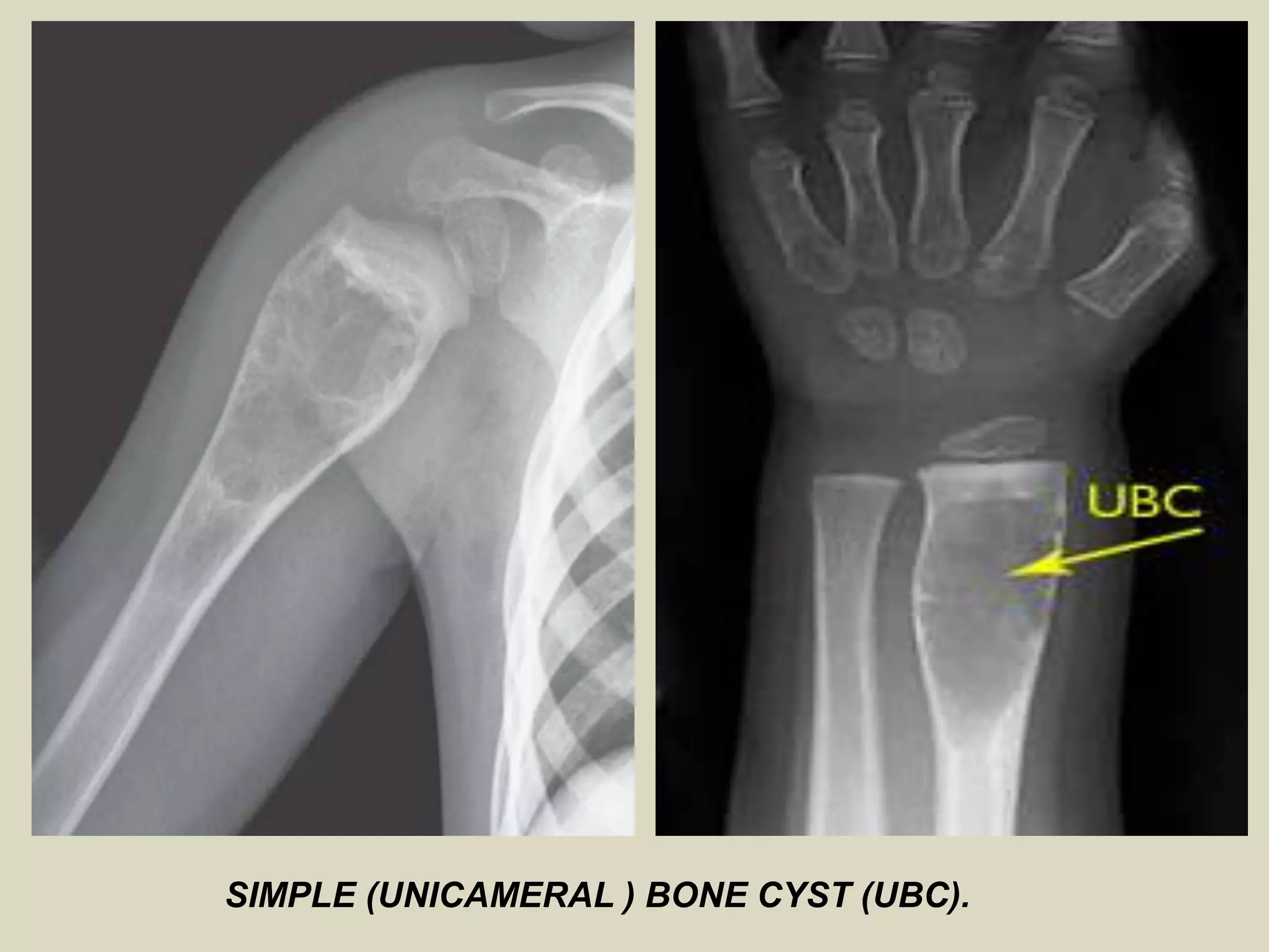 SIMPLE (UNICAMERAL ) BONE CYST (UBC).
 