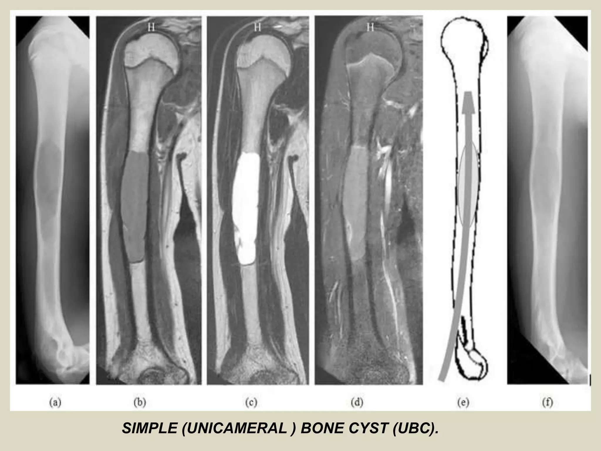 SIMPLE (UNICAMERAL ) BONE CYST (UBC).
 