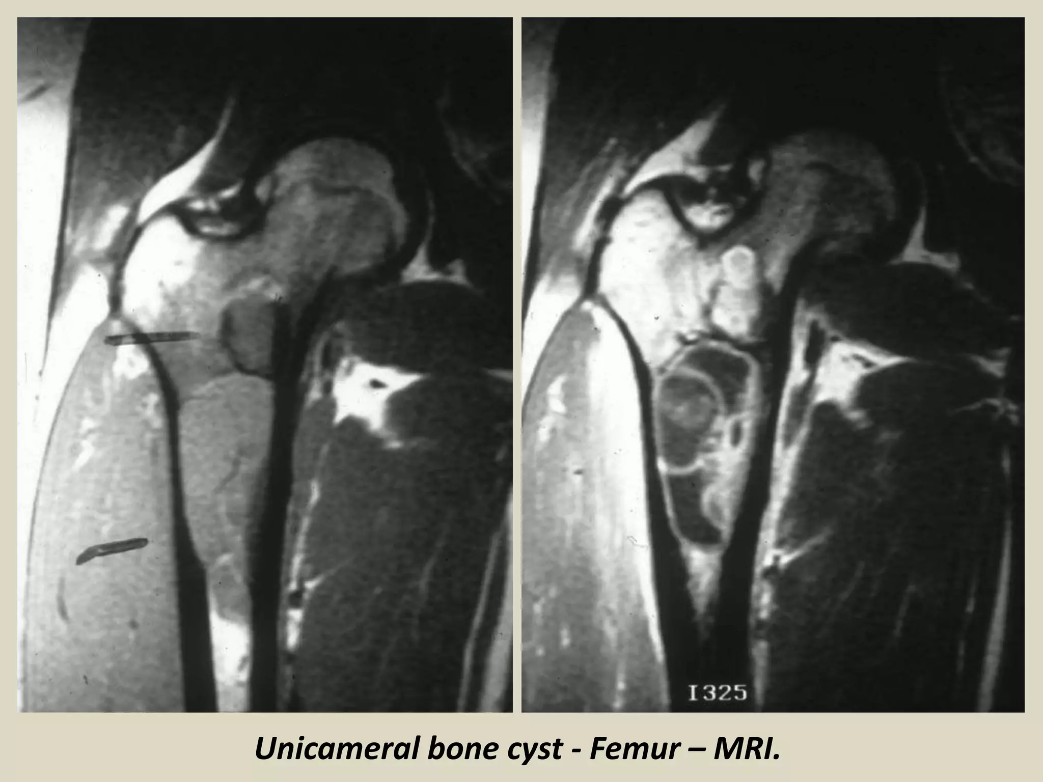 Unicameral bone cyst - Femur – MRI.
 