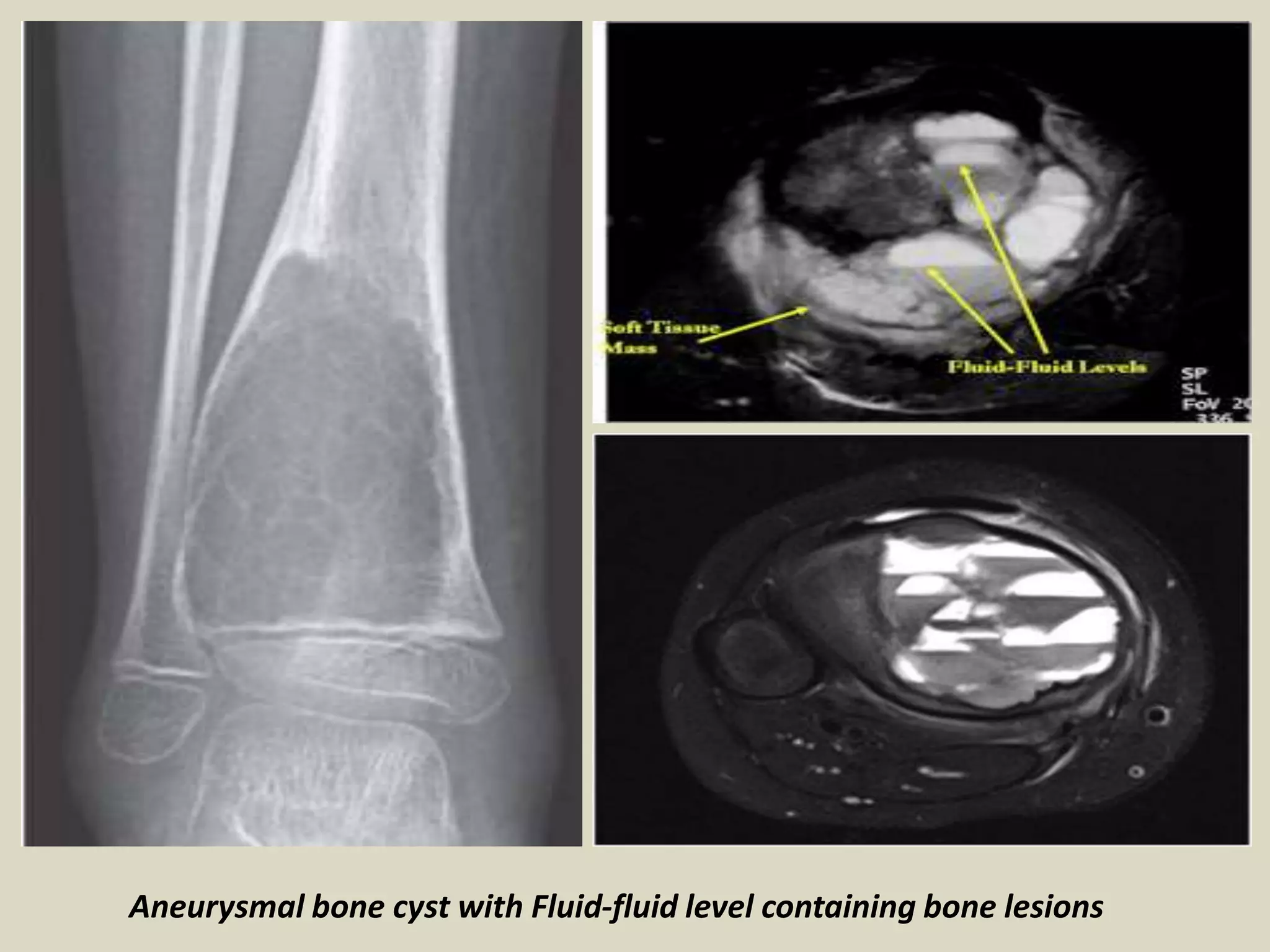 Aneurysmal bone cyst with Fluid-fluid level containing bone lesions
 